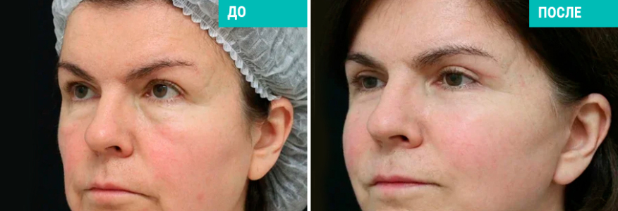 Подтяжка лица