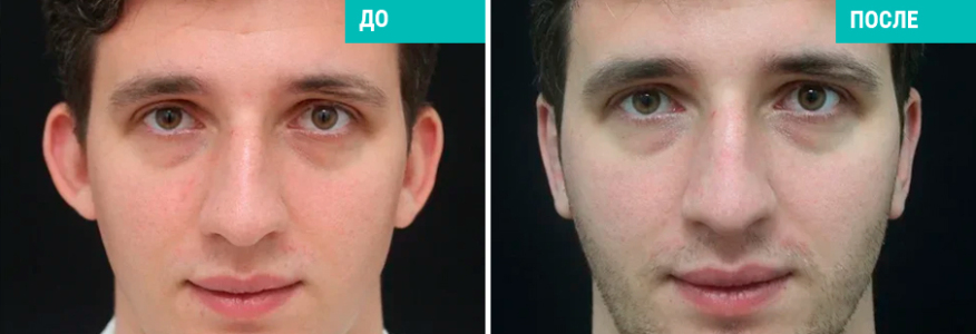 Отопластика