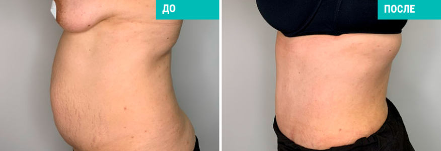 Абдоминопластика