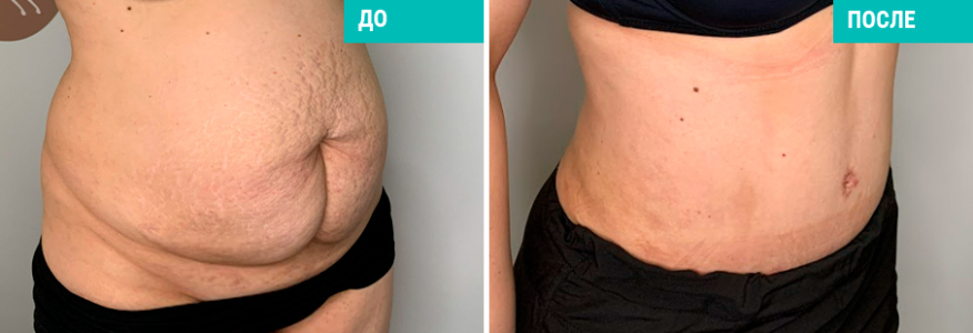 Абдоминопластика