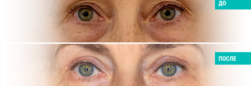 Блефаропластика