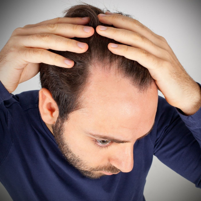 Что делать при облысении