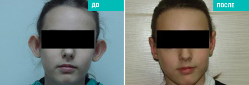 Отопластика