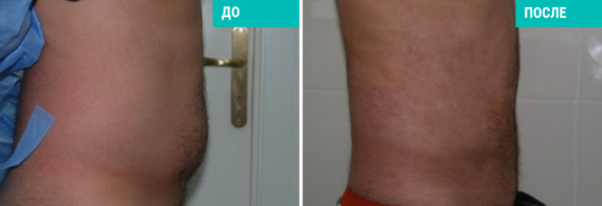 Липосакция