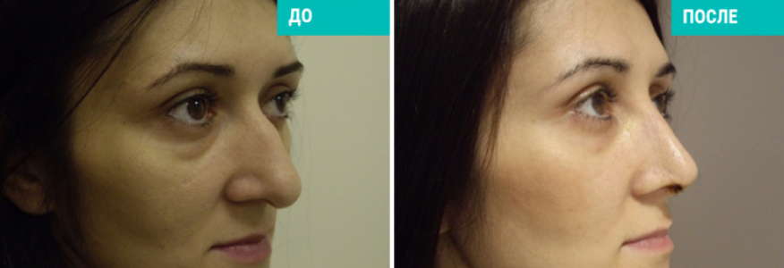 Ринопластика