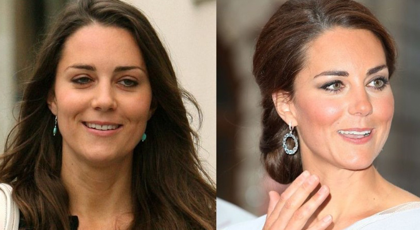 Кейт Миддлтон до и после «детского ботокса»