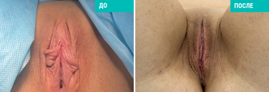 Лабиопластика