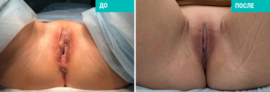 Лабиопластика