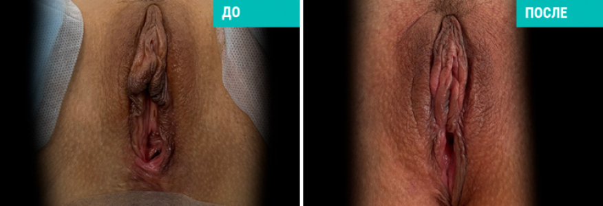 Лабиопластика