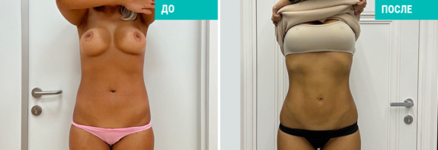 Липосакция живота и боков