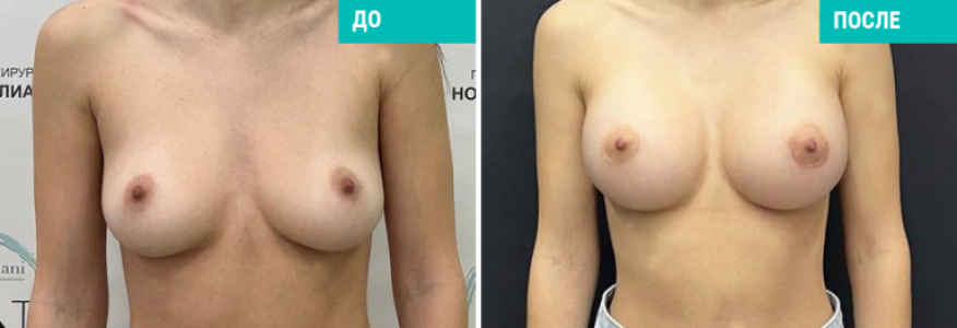 Увеличение груди