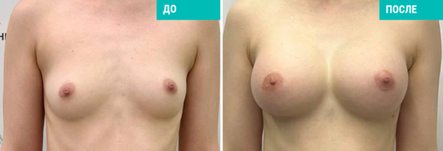 Увеличение груди