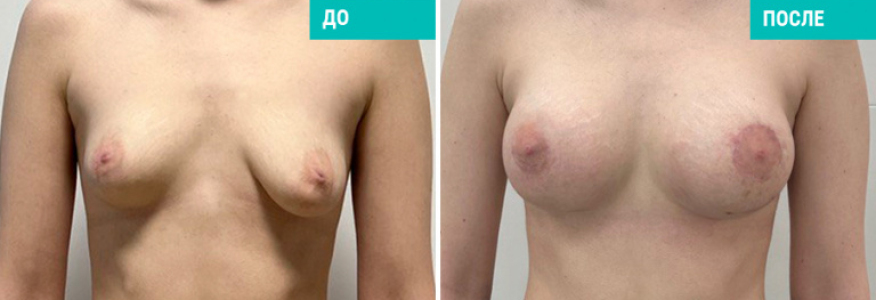 Увеличение груди