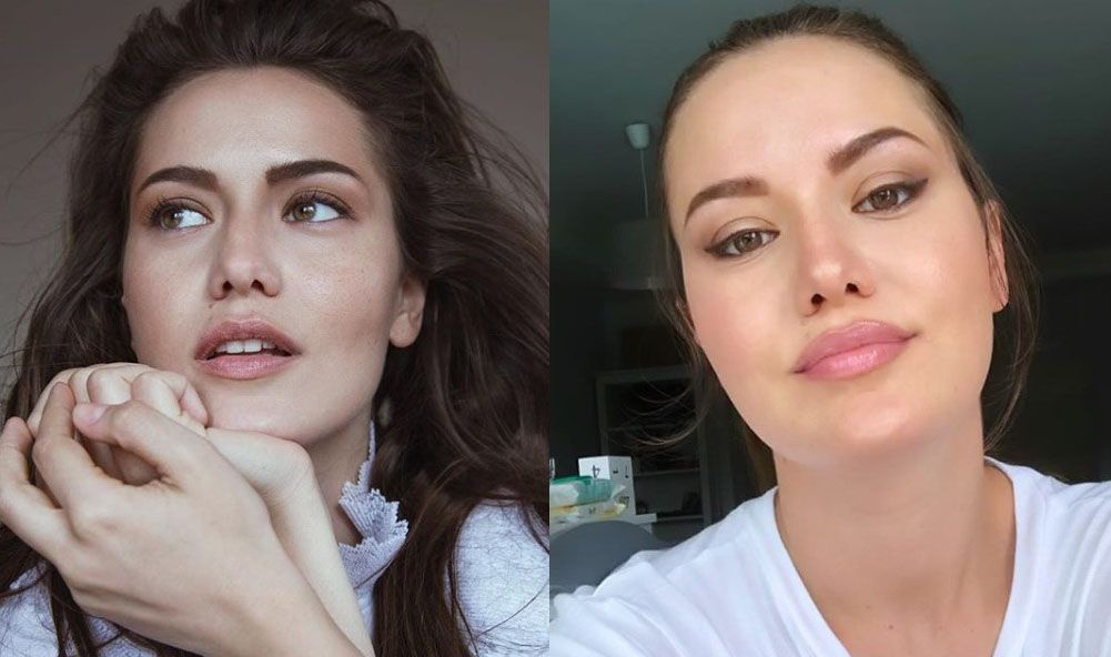 Благодаря инъекциям гиалуроновой кислоты губы стали пухлее и выразительнее