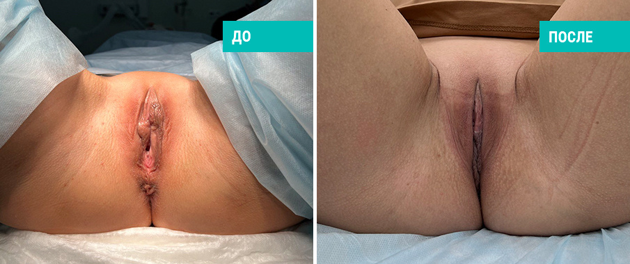 Фото пациентки Н. Б. Иоселиани до и после лабиопластики