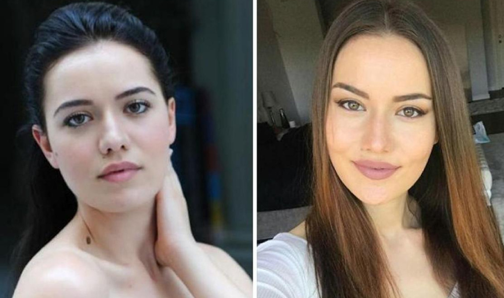 Благодаря ментопластике, удалению комков Биша и нитям актрисе удалось создать более острые скулы, более четкие линии нижней трети лица и сделать изящным подбородок