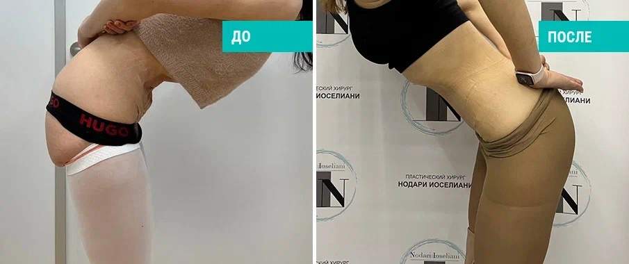 Фото пациентки Н. Б. Иоселиани до и после абдоминопластики