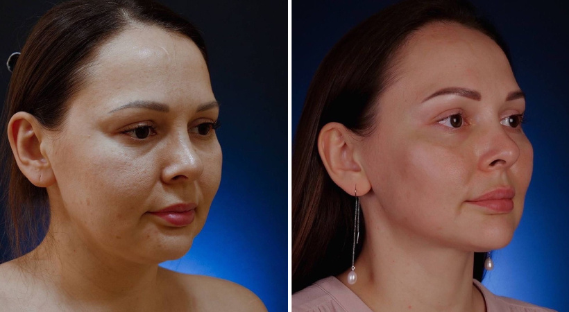 До и после аквалифтингфа. Пластический хирург М. В. Егорова