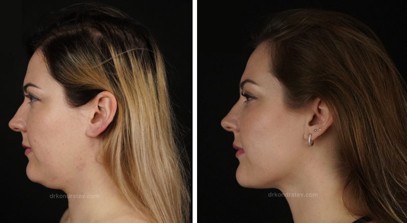 Фото до и после аквалифтинга. Пластический хирург Д. Г. Кондратьев