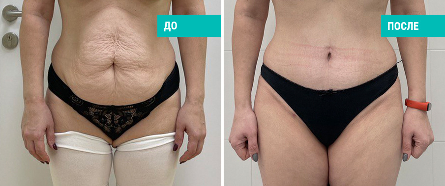 Фото пациентки Н. Б. Иоселиани до и после абдоминопластики
