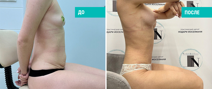 Фото пациентки Н. Б. Иоселиани до и после комплексного восстановления (маммопластика + абдоминопластика)