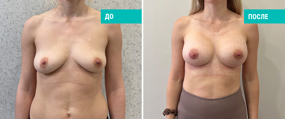 Фото пациентки Н. Б. Иоселиани до и после увеличения груди с помощью имплантов