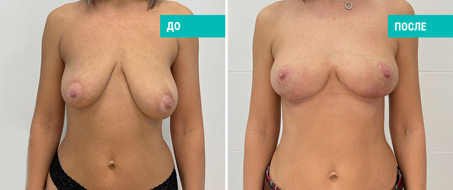 Фото пациентки Н. Б. Иоселиани до и после подтяжки груди без установки имплантов
