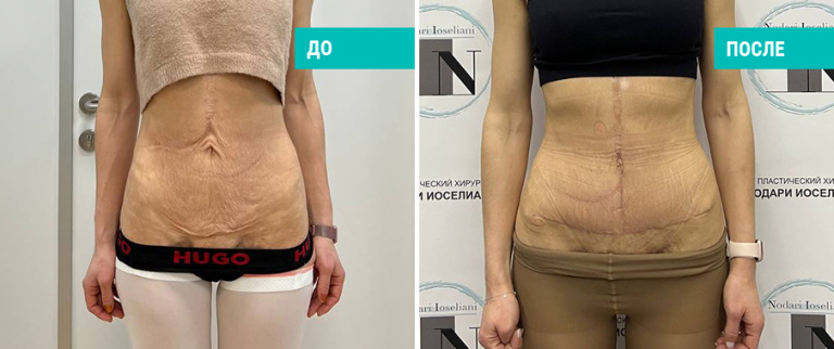 Фото пациентки Н. Б. Иоселиани до и 1 месяц после абдоминопластики (рубец на первичной стадии формирования)