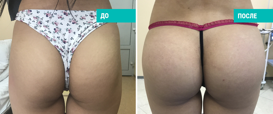 Пациентка  Д. В. Крысина до и после операции