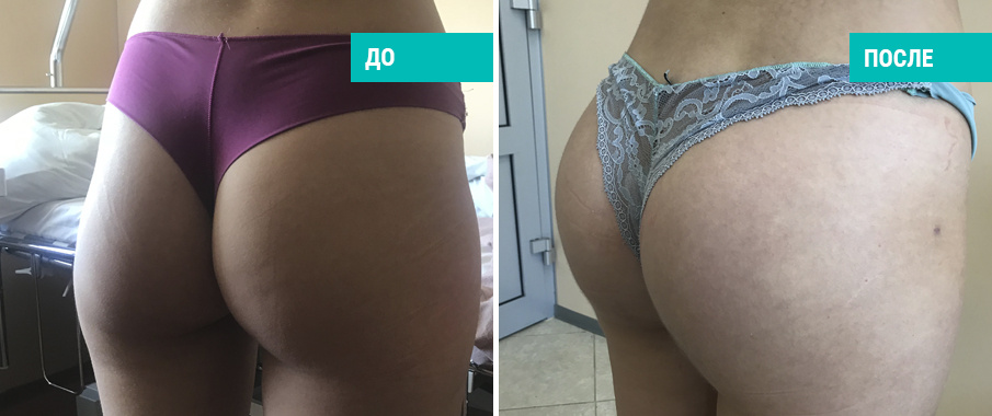 Пациентка  Д. В. Крысина до и после операции