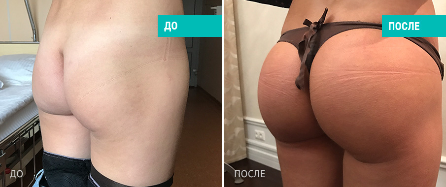 Пациентка  Д. В. Крысина до и после операции