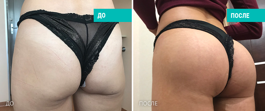 Пациентка  Д. В. Крысина до и после операции