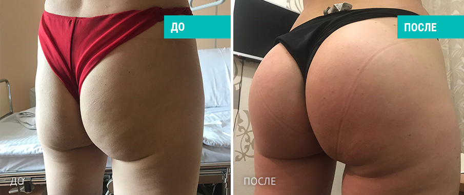 Пациентка  Д. В. Крысина до и после операции