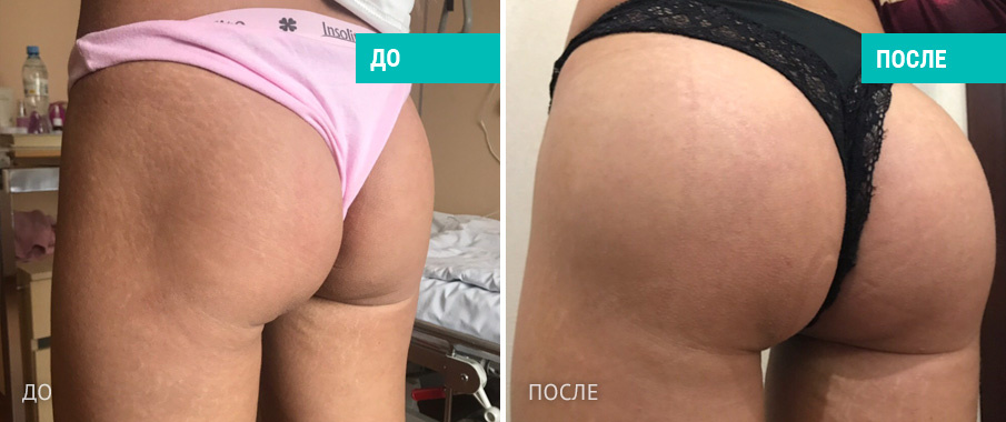 Пациентка  Д. В. Крысина до и после операции