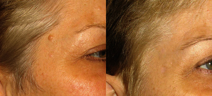 До и после радиоволнового удаления родинки. Специалист Воротникова Ирина Валентиновна