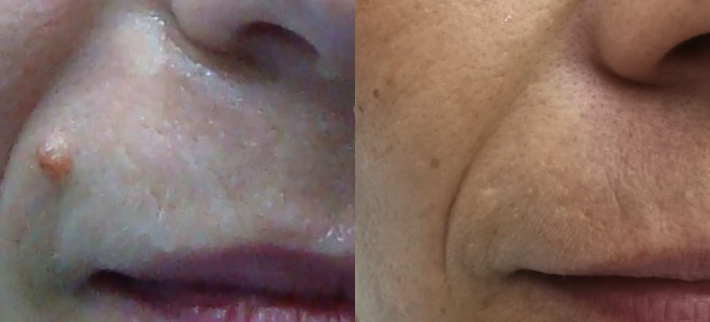 До и после лазерного удаления родинки. Специалист Щербакова Виктория Вениаминовна