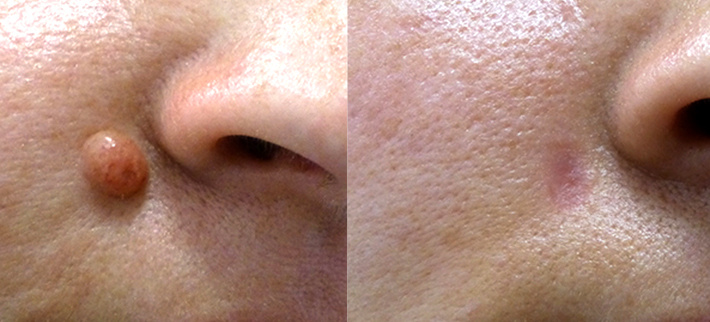 До и после хирургического удаления родинки. Специалист Щербакова Виктория Вениаминовна