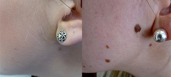 До и после криодеструкции родинки. Специалист Конте Мария Гавриловна