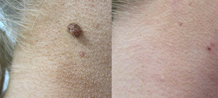 До и после радиоволнового удаления родинки. Специалист Оганесянц Смбат Мартиросович