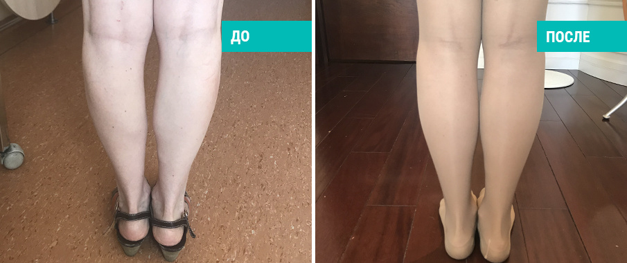 До и после пластики голеней.. Пациентка Д. В. Крысина