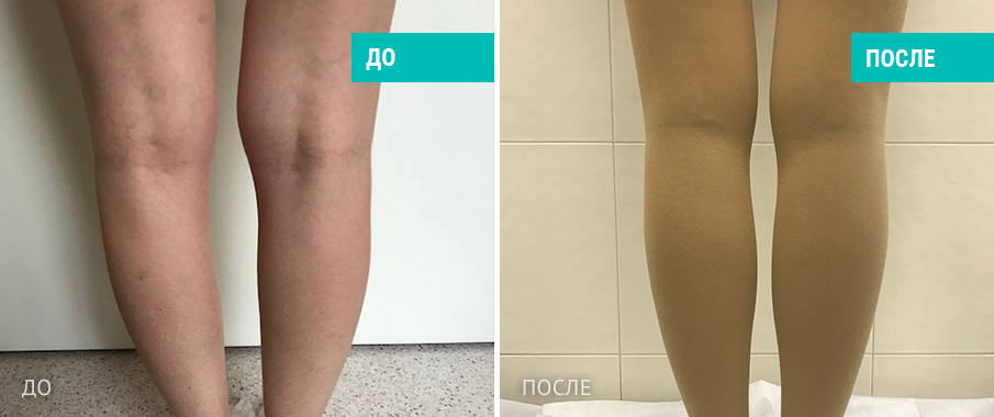 До и после пластики голеней.. Пациентка Д. В. Крысина