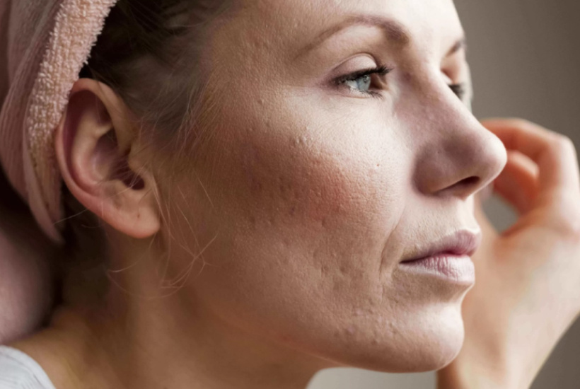 Первые морщины