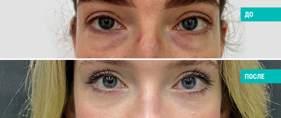 До и после нижней блефаропластики. Пластический хирург Н. Б. Иоселиани