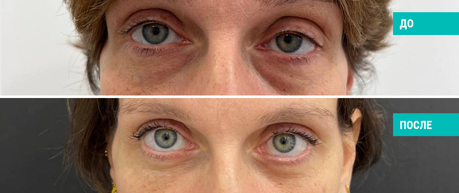 До и после нижней блефаропластики. Пластический хирург Н. Б. Иоселиани