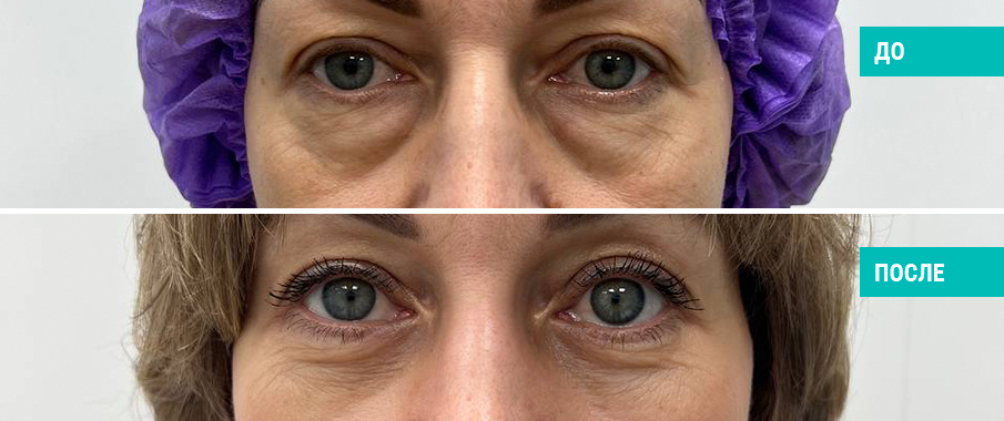 До и после нижней блефаропластики. Пластический хирург Н. Б. Иоселиани