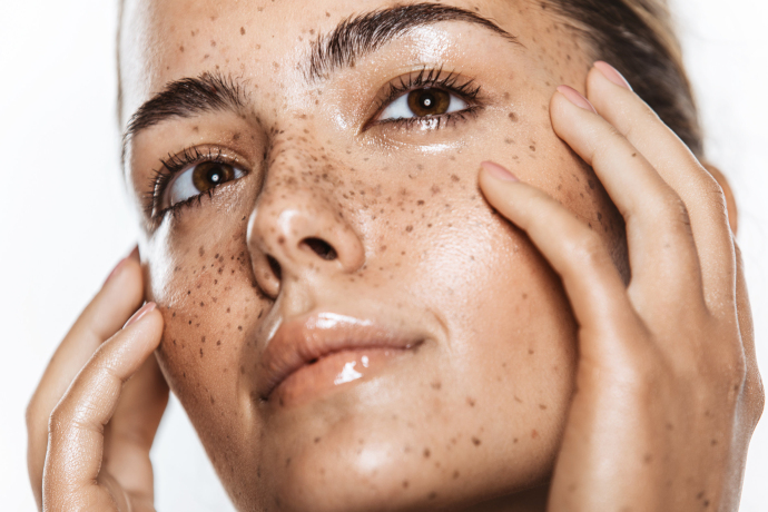 Как избавиться от пигментных пятен
