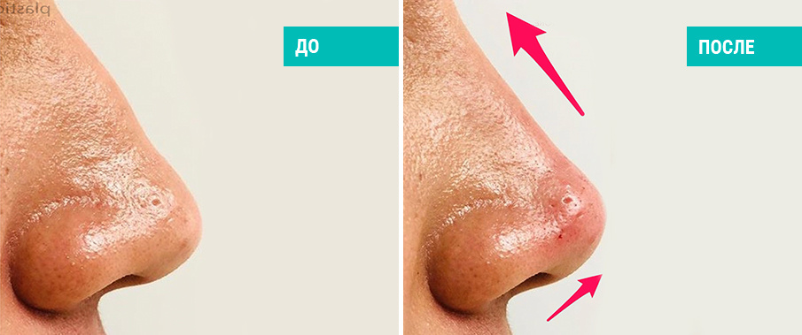 До и после контурной пластики носа. Косметолог Стамболцян Е. В.