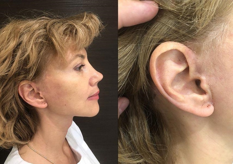 Фото через 16 дней после SMAS-лифтинга. Пластический хирург Е. С. Кудинова