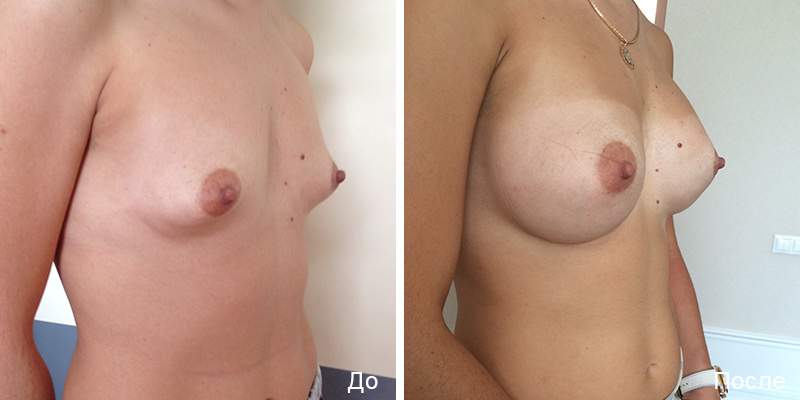Пациентка Д. В. Крысина до и после увеличения груди с установкой имплантов