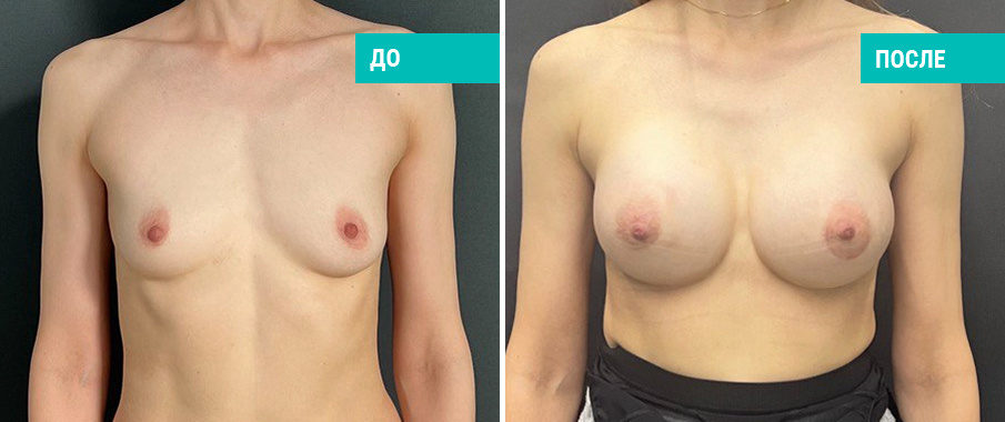 Фото до и после установки имплантов. Пациентка Н. Б. Иоселиани